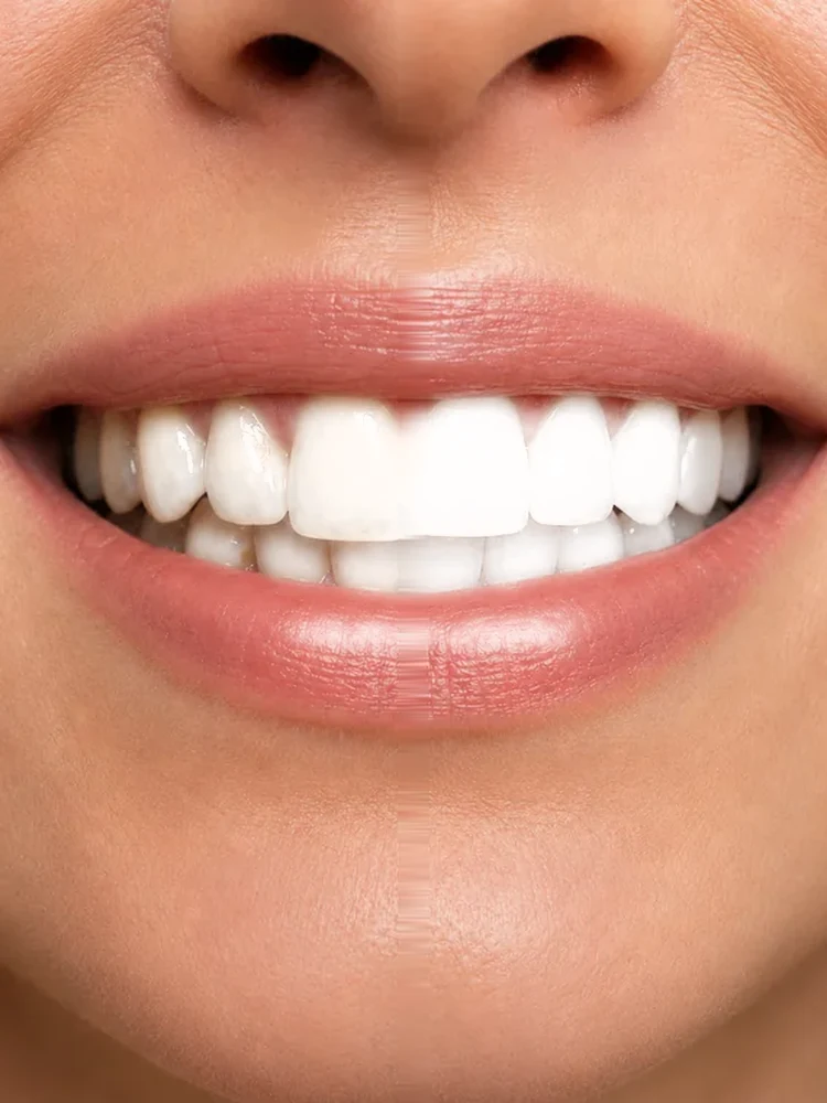 After: bright, even smile