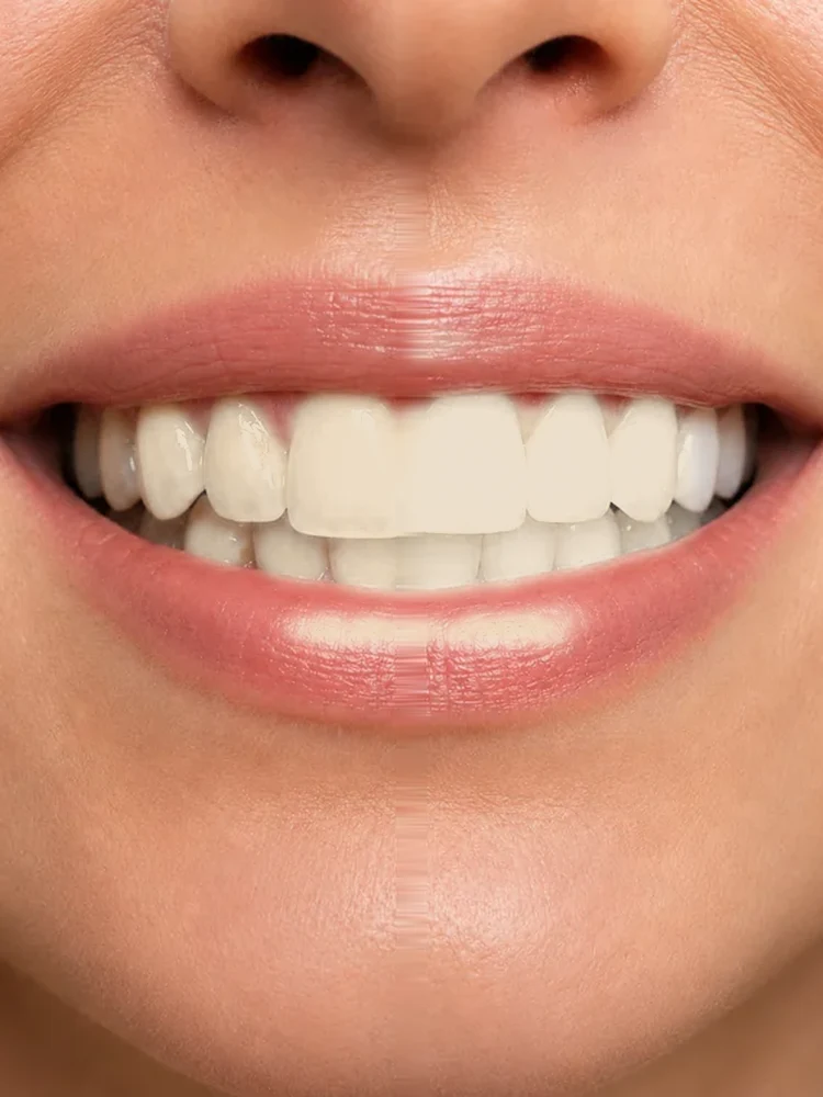 Before: natural tooth shade
